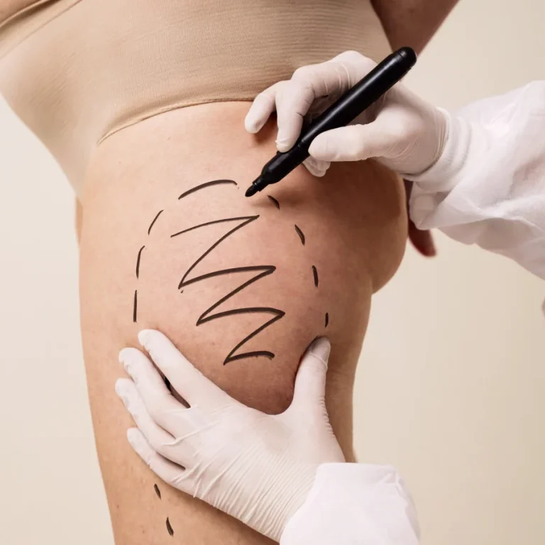 home-1-8-tummy-tuck.webp